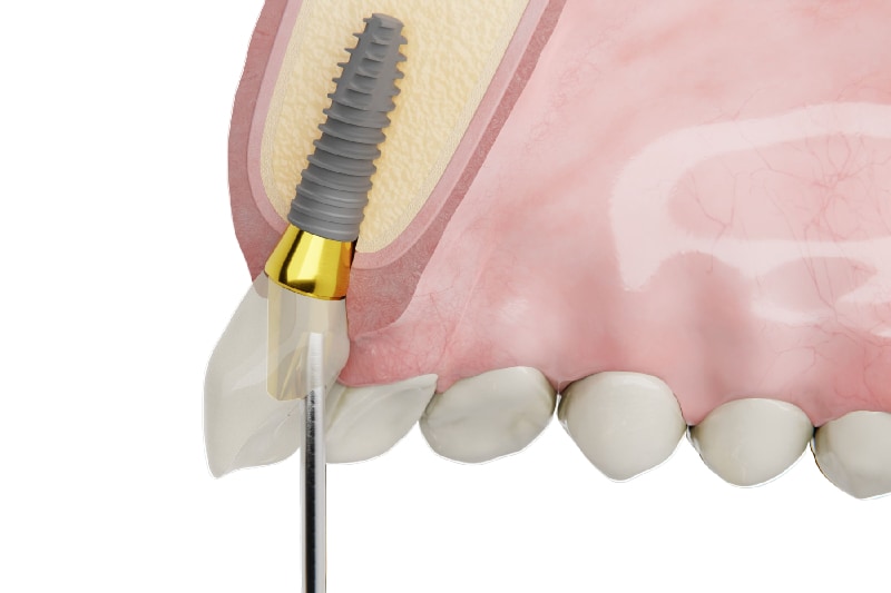 人工植牙植體植入齒槽骨的結構示意圖