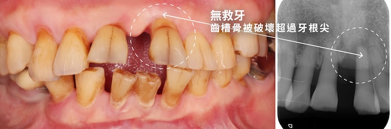 嚴重牙周病案例，上顎門牙齒槽骨嚴重流失形成無救牙，X光顯示骨破壞已超過牙根尖