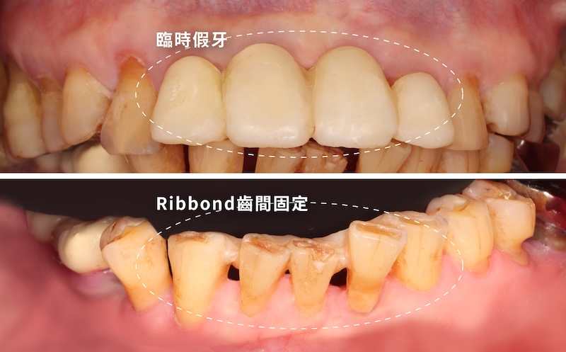 嚴重牙周病治療先拔除左上無救牙並裝臨時假牙，下顎前牙以Ribbond齒間固定術穩定齒列