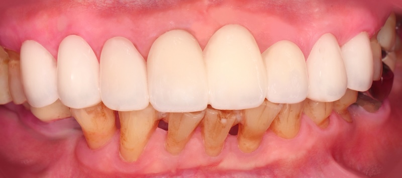 以上顎全鋯冠牙橋與全瓷貼片完成牙齒美學修復