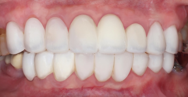 嚴重牙周病完成牙齒美學重建後的咬合狀態，上下顎齒列整齊並恢復穩定咬合
