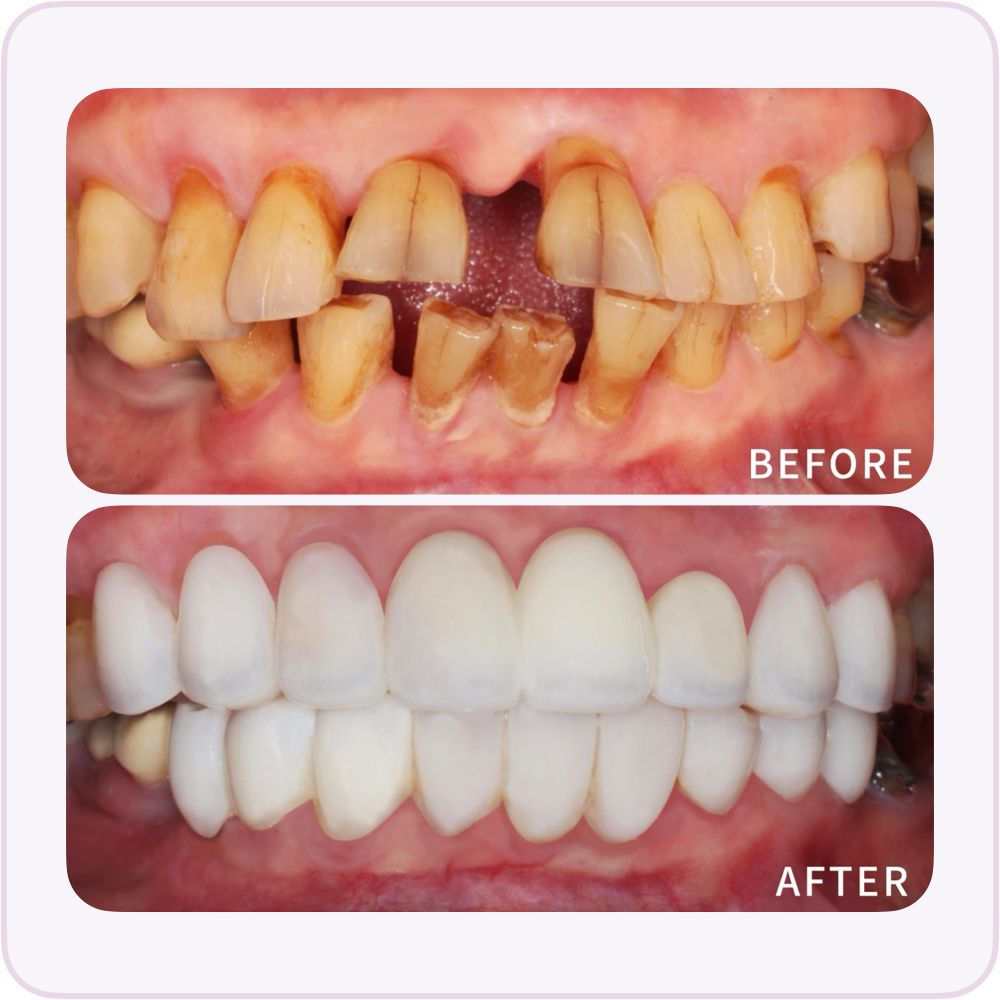嚴重牙周病案例-水雷射牙周治療-全鋯冠-全瓷貼片-治療前後比較