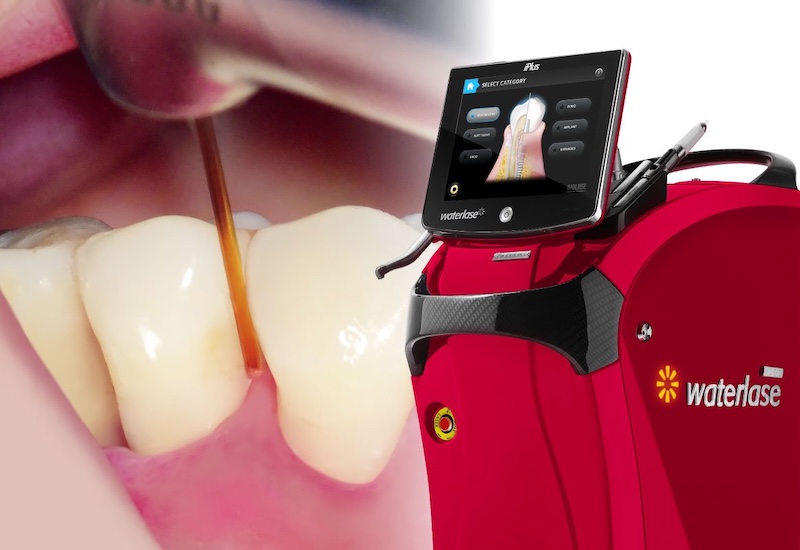 水雷射牙周治療-Waterlase水雷射設備與治療示意圖