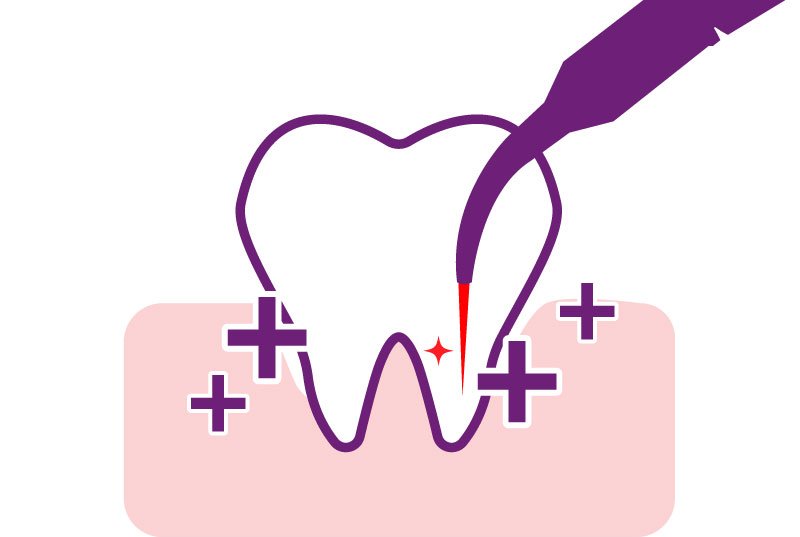 水雷射牙周治療特色：活化增生
