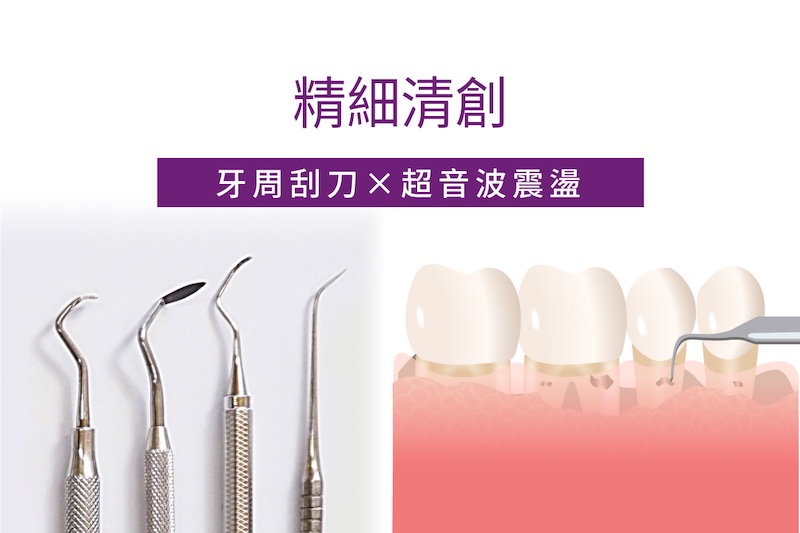 水雷射牙周治療步驟一精細清創示意圖，使用牙周刮刀與超音波震盪清除牙結石與感染來源