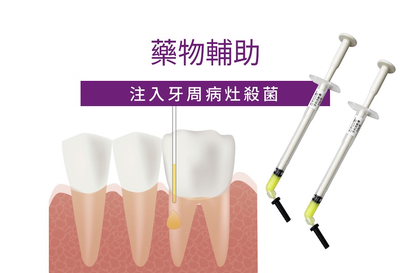 水雷射牙周治療步驟二藥物輔助示意圖，專用藥膏深入牙周囊袋抑制感染因子
