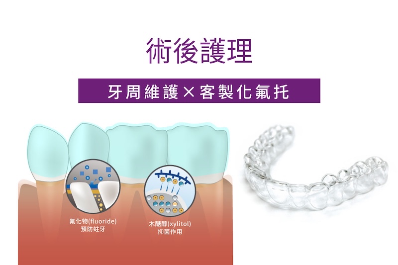 水雷射牙周治療步驟四術後護理示意圖，客製化氟托與牙周維護強化穩定性