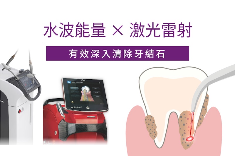 水雷射牙周治療-設備與治療圖式