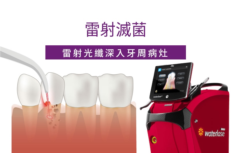 水雷射牙周治療步驟三雷射滅菌示意圖，雷射光纖深入牙周病灶進行深層滅菌