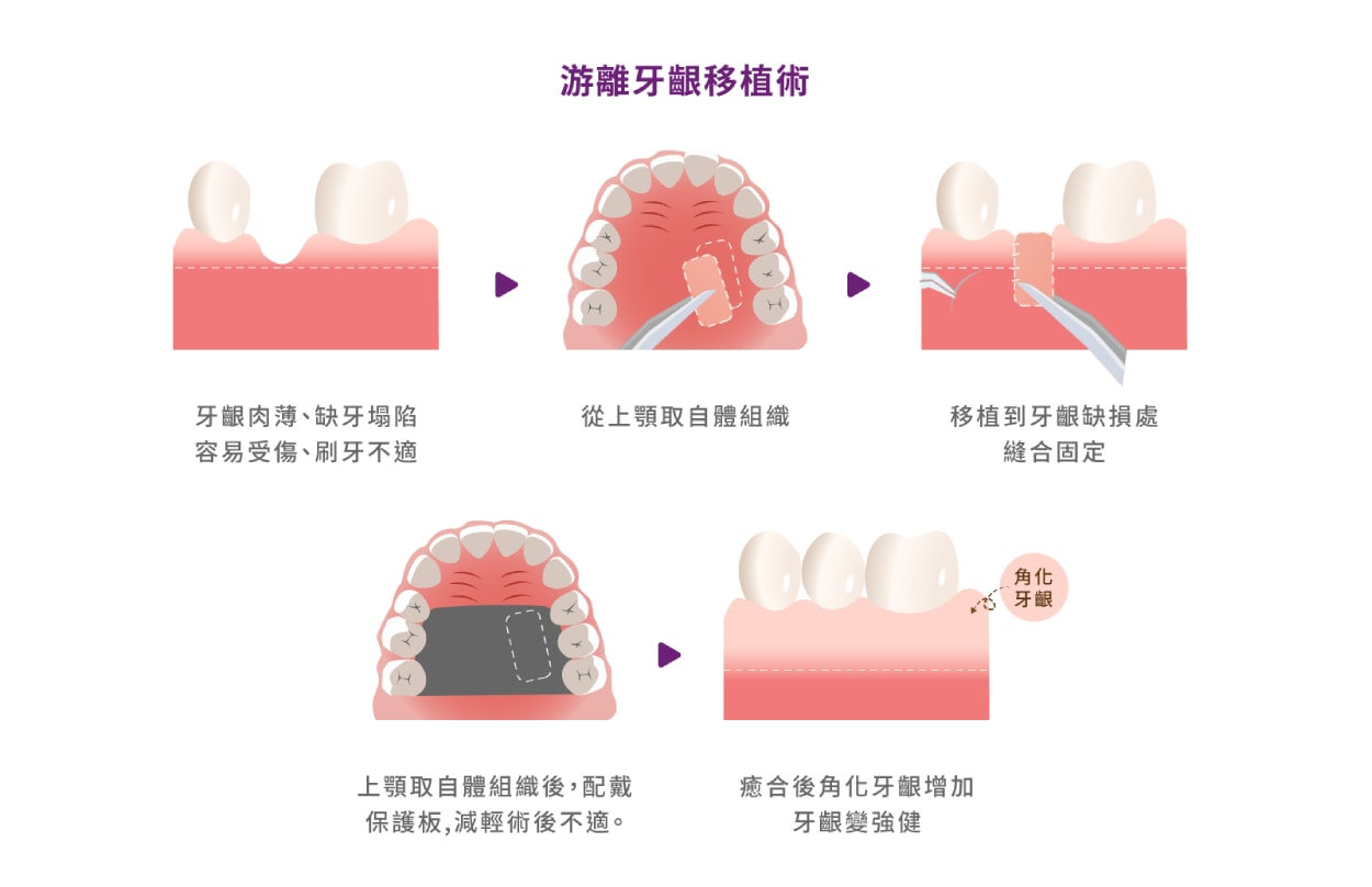 游離牙齦移植術流程示意，取上顎自體牙齦組織移植，增加角化牙齦強度