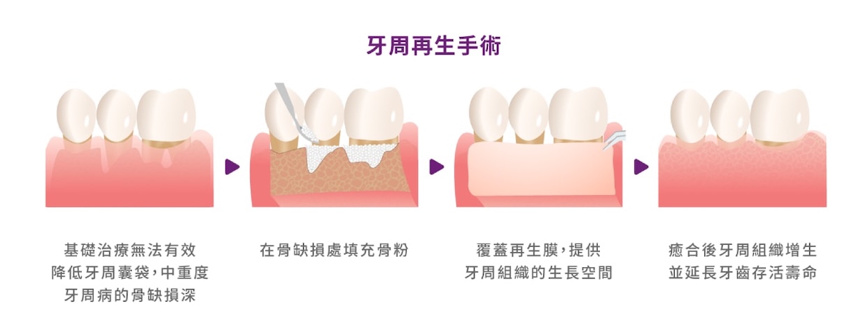 牙周再生手術流程示意，包含骨粉填補、再生膜覆蓋與組織修復過程