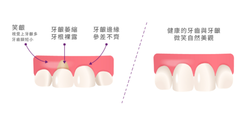 笑齦、牙齦萎縮與牙齦邊緣不整齊問題示意，與健康牙齦比例對照圖