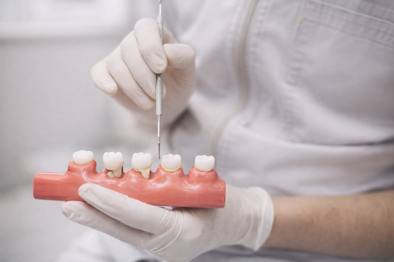 牙醫師以牙周模型說明牙周病手術治療示意