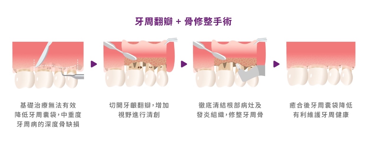 牙周翻瓣與骨修整手術流程示意，包含翻瓣清創、修整齒槽骨與術後癒合結果