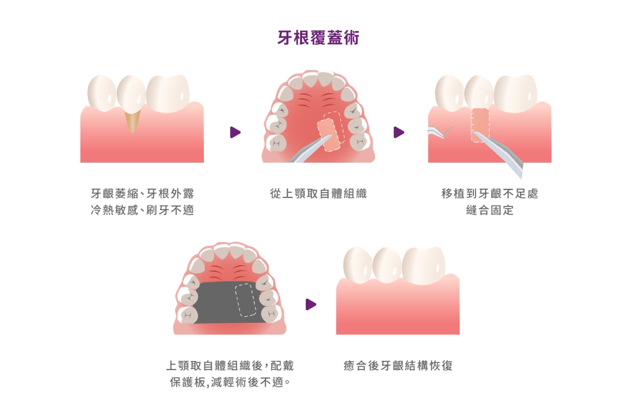 牙根覆蓋術流程示意，取上顎自體牙齦組織移植覆蓋牙根