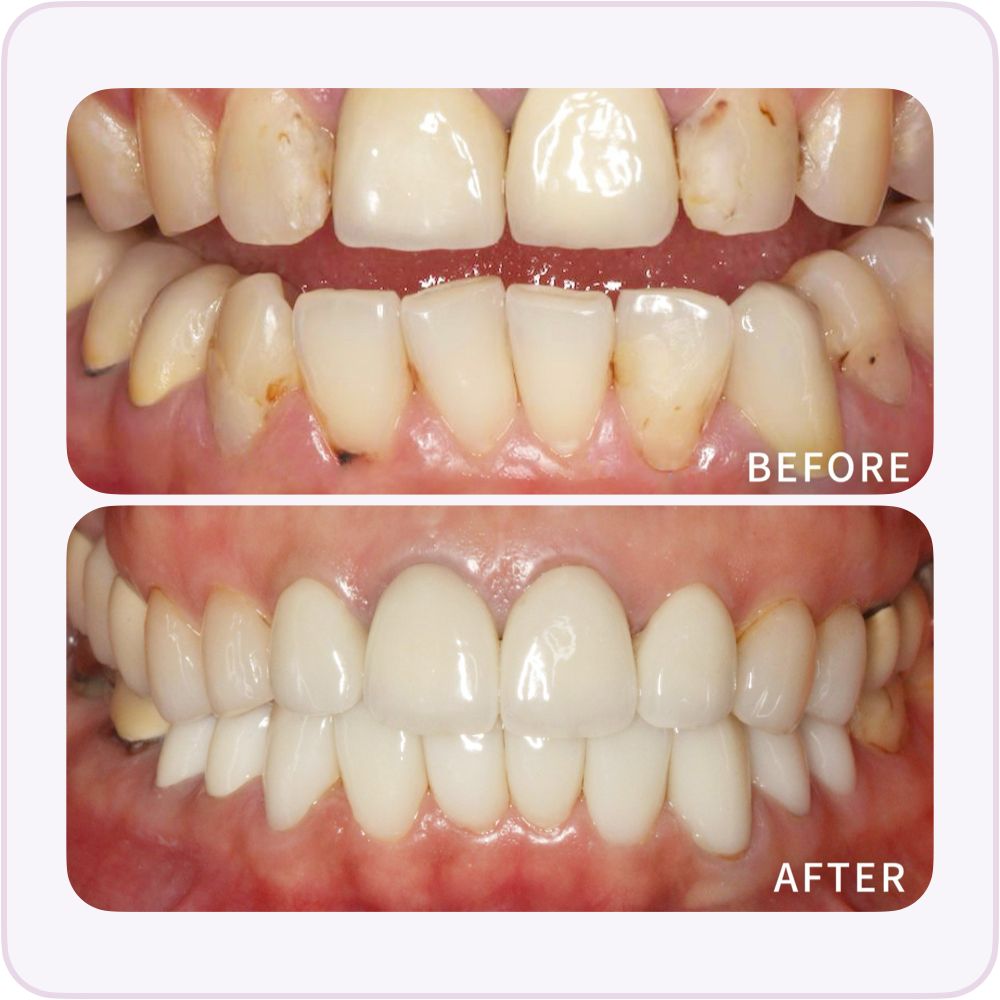 牙齒敏感-蛀牙-輕度牙周病治療-全瓷冠-治療前後比較