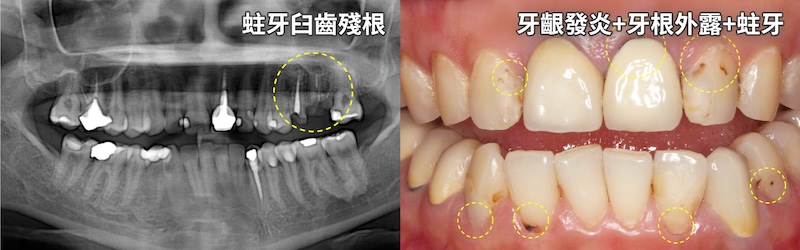 牙齒敏感與蛀牙患者治療前牙齒外觀與X光影像，顯示多處蛀牙與牙齒狀況