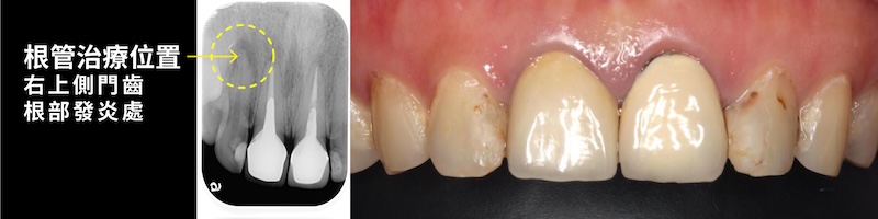 門牙根管治療後以全瓷冠修復牙齒外觀與功能
