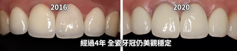全瓷冠修復四年後牙齒外觀依然穩定自然