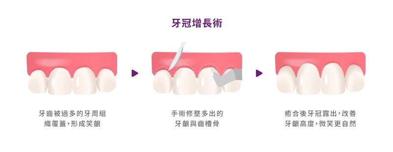 牙冠增長術流程示意，調整牙齦比例為全瓷修復建立良好條件