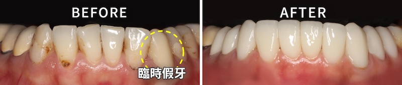 下顎牙冠增長術後結合全瓷冠與貼片修復的治療前後比較