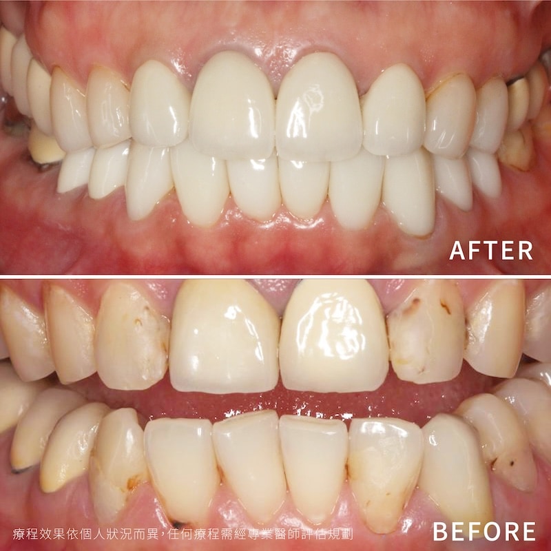 蛀牙與牙齒敏感治療後全瓷冠修復前後比較，牙齒外觀與咬合恢復