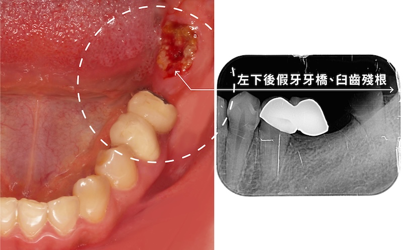 左下後牙區舊牙橋清潔不易導致臼齒蛀斷為殘根，X光顯示牙根狀況需評估