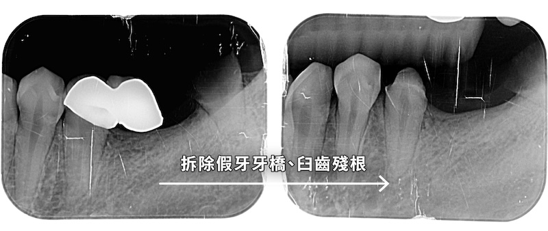 牙橋拆除前後X光影像，比較左下後牙區牙根與齒槽骨狀況