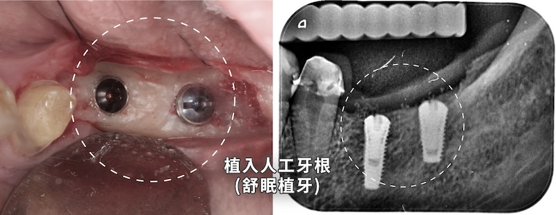 舒眠植牙過程，在鎮靜狀態下植入人工牙根