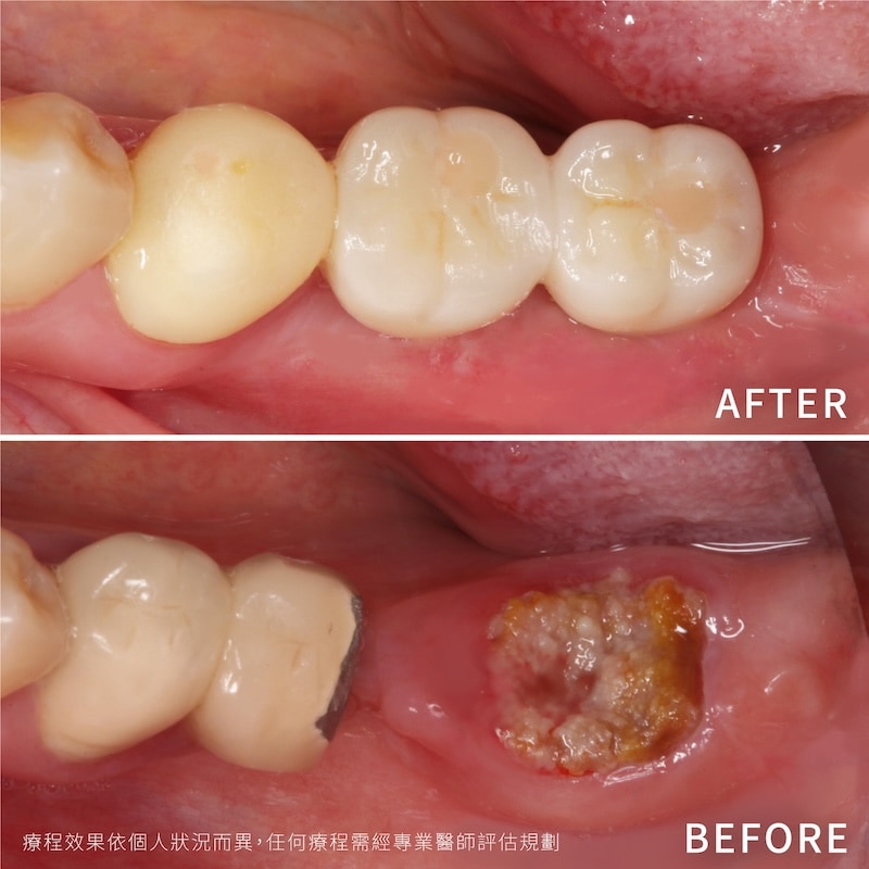 輕微牙周病植牙案例，左下後牙區缺牙治療前後比較，植牙重建後恢復正常咬合