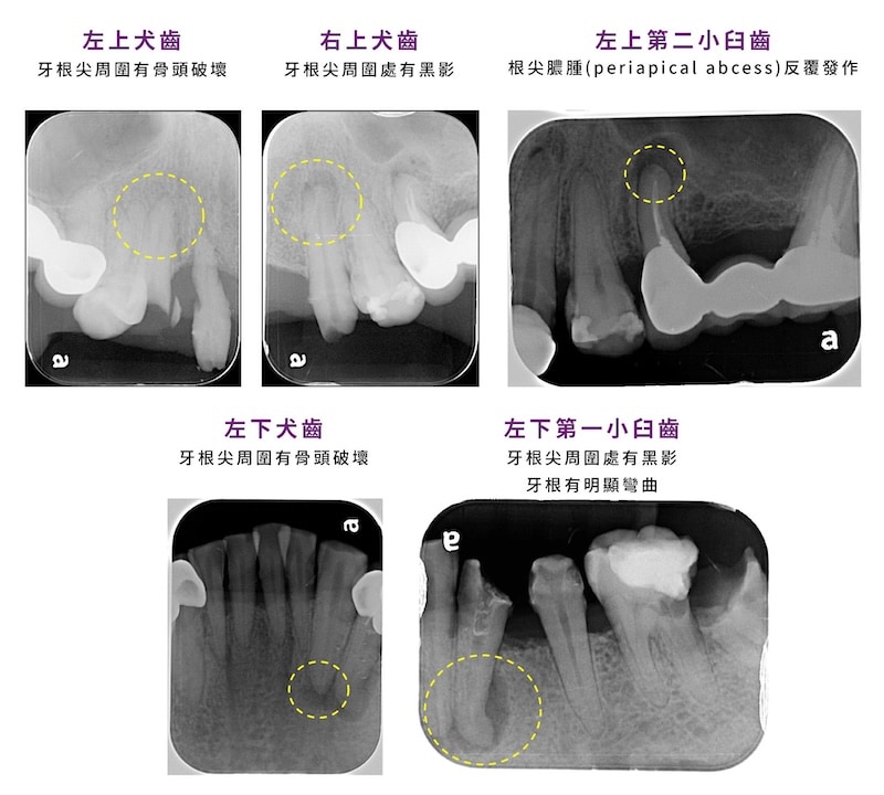 5顆需根管治療牙位標示，包含多處根尖骨破壞與感染病灶