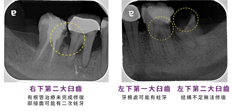 右下第二大臼齒根管治療未完成合併疑似二次蛀牙，左下第一大臼齒牙根區疑似蛀牙，左下第二大臼齒結構不足無法修復