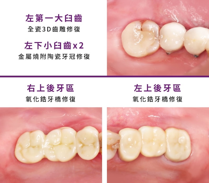 後牙區全瓷冠、全鋯冠與3D齒雕修復，恢復臼齒外觀與咬合功能