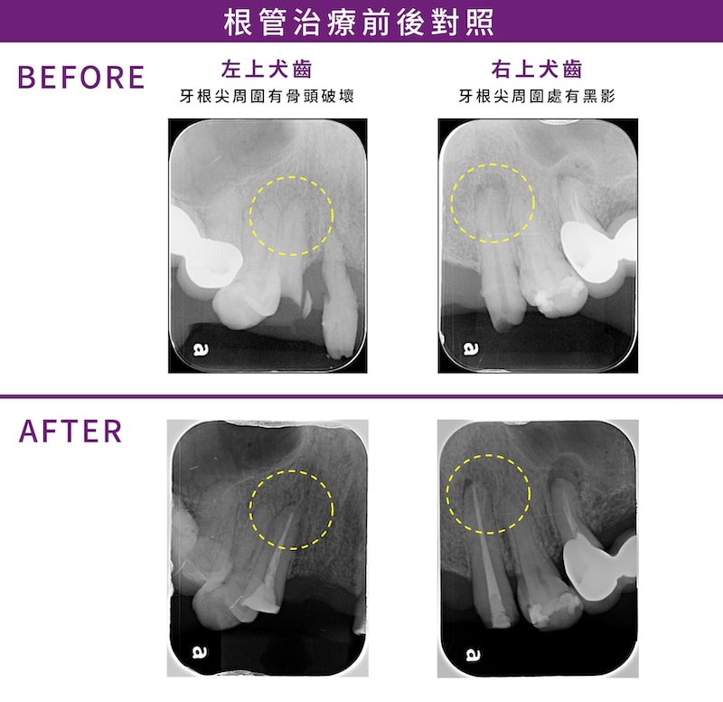 左上與右上犬齒根管治療前後對照