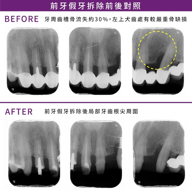 前牙假牙拆除前後X光對照,顯示牙周齒槽骨流失約30%,左上犬齒區骨缺損,拆除後可見局部牙根尖周圍狀況