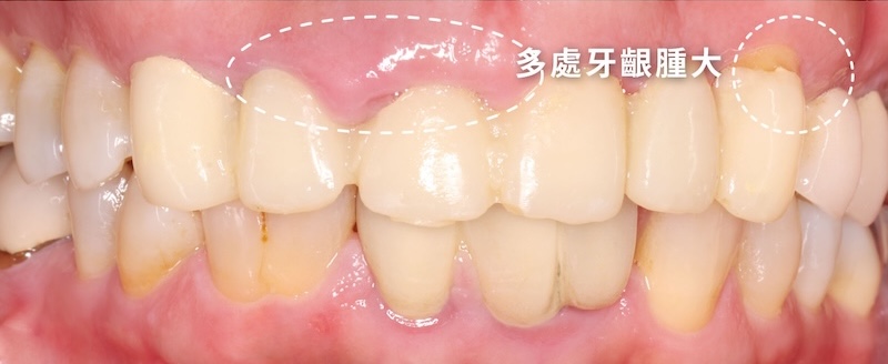 高血壓患者前牙牙齦腫大
