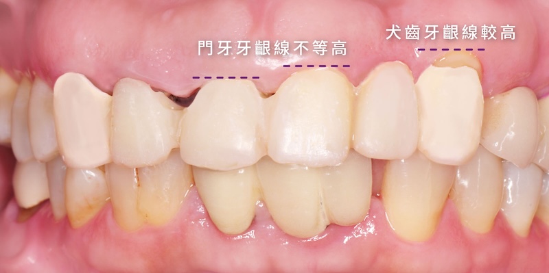 前牙牙齦線不對稱與犬齒牙齦偏高,透過水雷射微創牙冠增長術調整牙齦高度以改善美觀