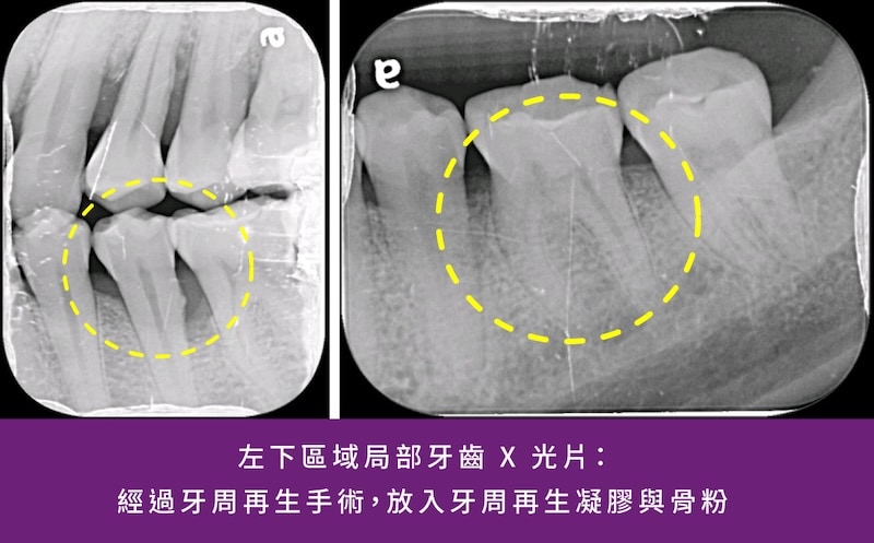 左下局部X光影像,標示牙周再生手術評估與治療區域