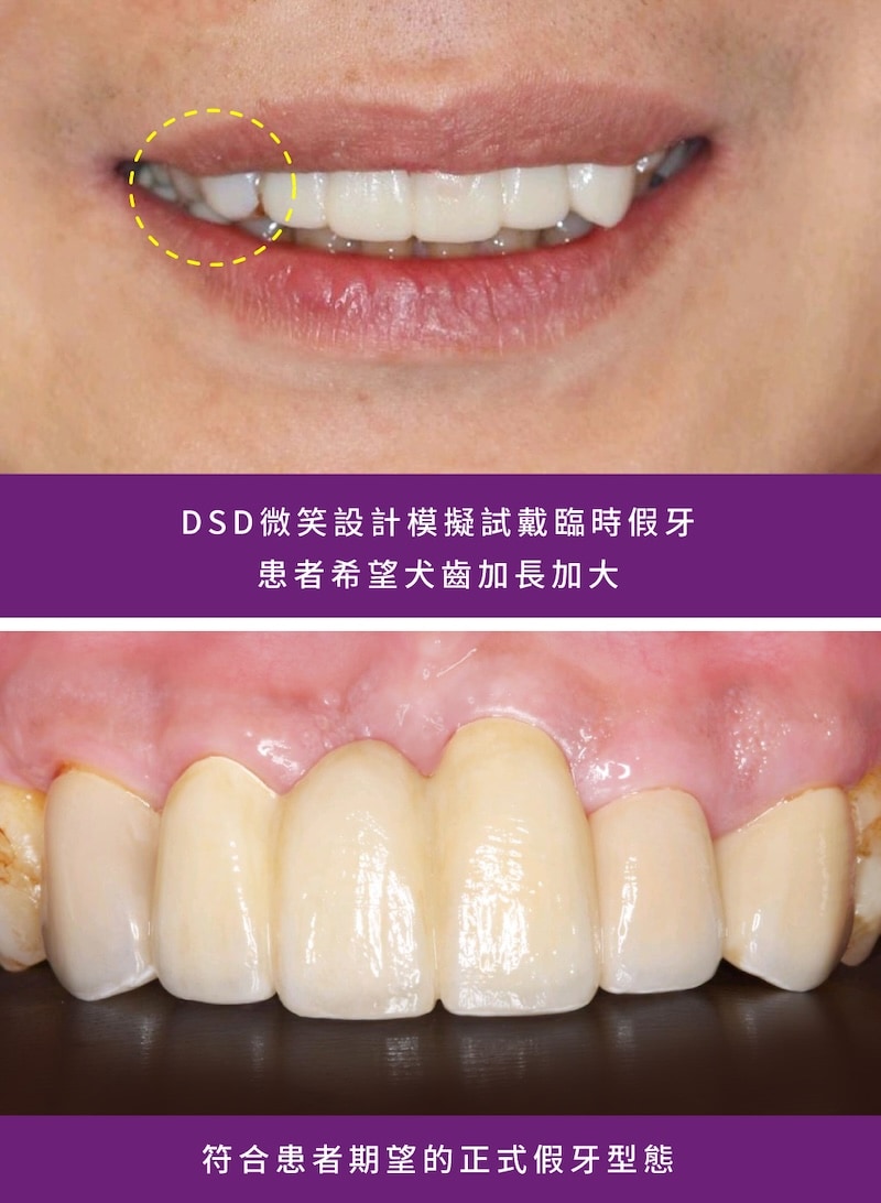 DSD數位微笑設計與模擬試戴,依患者期待調整犬齒形態