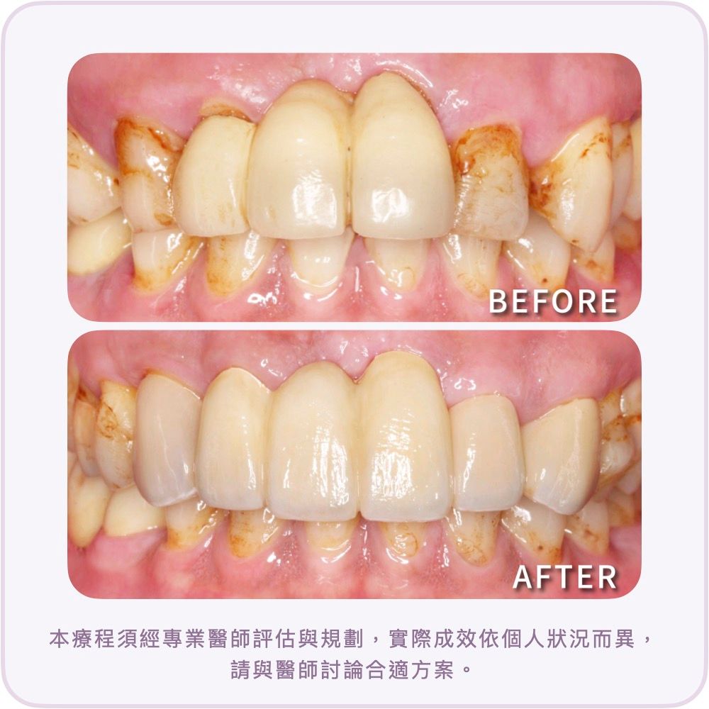 嚴重牙周病-牙周病雷射治療-dsd微笑設計-全瓷貼片-治療前後比較