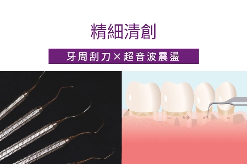 水雷射牙周治療步驟一精細清創示意圖，使用牙周刮刀與超音波震盪清除牙結石與感染來源